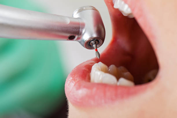 Best Root Canal Emergency Dentist  in Meadow Woods, FL
